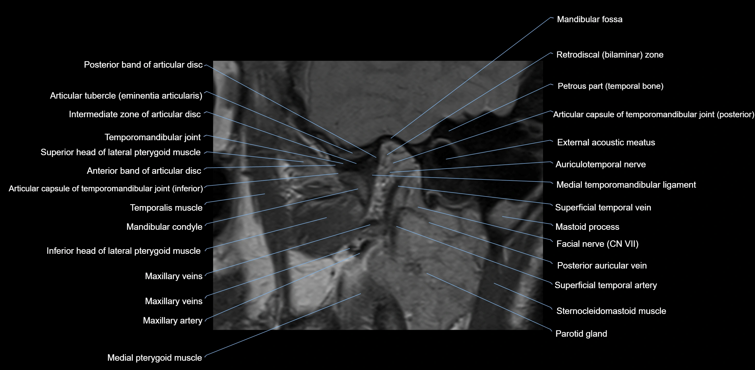 MRI TMJ sagittal open  mouth cross sectional 3T anatomy -img-00001-00009.webp